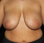 Breast Reduction - Case #3 Before
